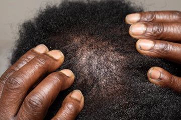 Shampoos with TRIOXIDIL® for Thinning Hair Treatment