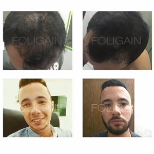 Saç derisinde saçların kapladığı alanı ve yüz kıllarını karşılaştıran öncesi ve sonrası fotoğrafları