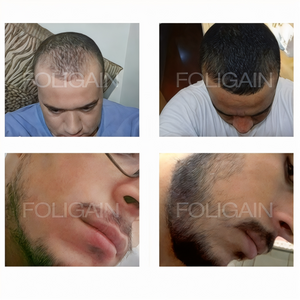 Saç çizgisinde saçların ve yanakta kılların kapladığı alanı karşılaştıran öncesi ve sonrası fotoğrafları