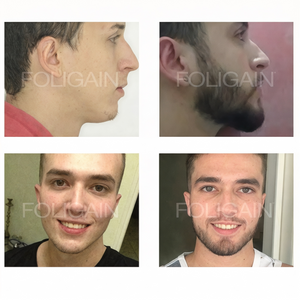 Sakalın kapladığı alanı yandan ve önden karşılaştıran öncesi ve sonrası fotoğrafları