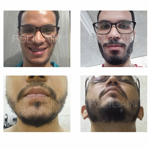 Sakalın kapladığı alanı önden ve çene altından karşılaştıran öncesi ve sonrası fotoğrafları